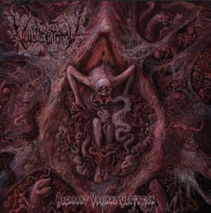Vulvectomy - Aberrant Vaginal Gestation（2025）